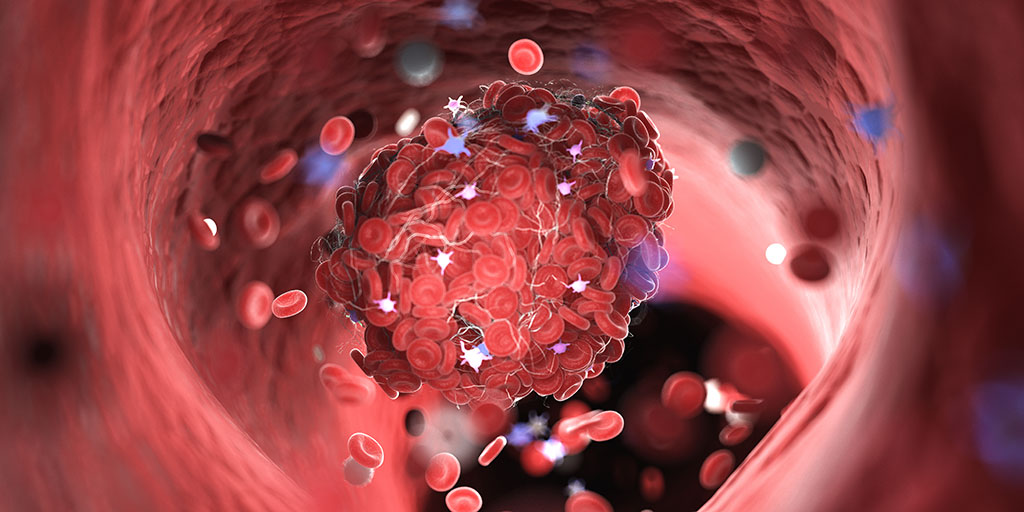 Ischemia – NEJM